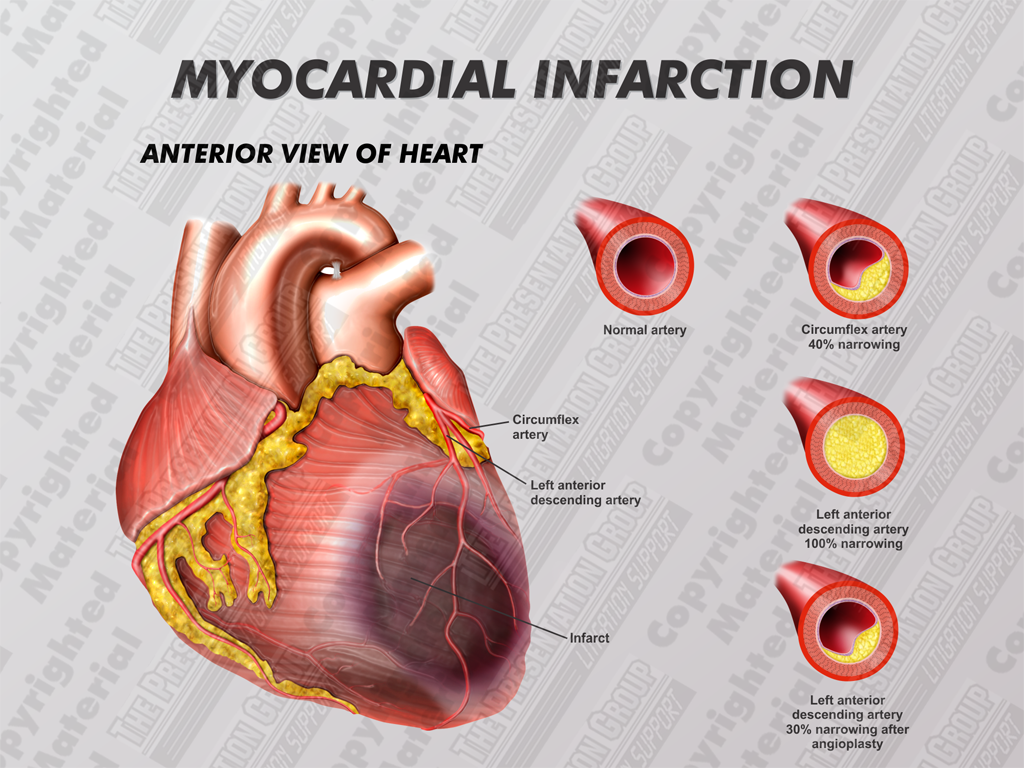 Myocardial Infarction MI 