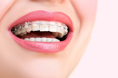 Niềng răng mắc cài sứ có ưu điểm gì? 