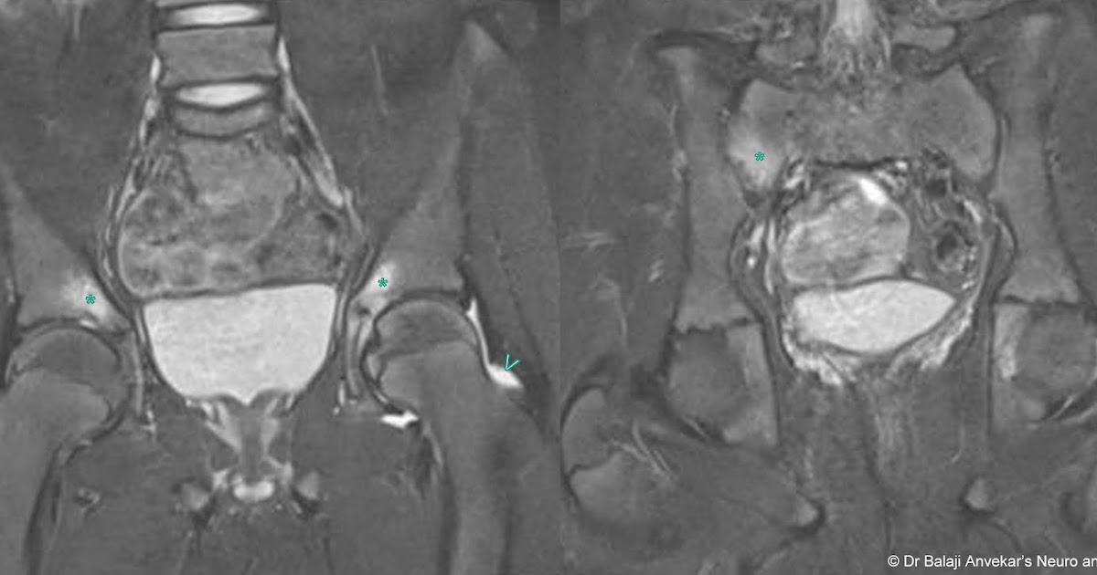 Dr Balaji Anvekar FRCR Vitamin C deficiency mimicking inflammatory