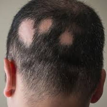 What are the main causes of alopecia? ! Alopecia Areata : Causes, Symptoms and Treatment