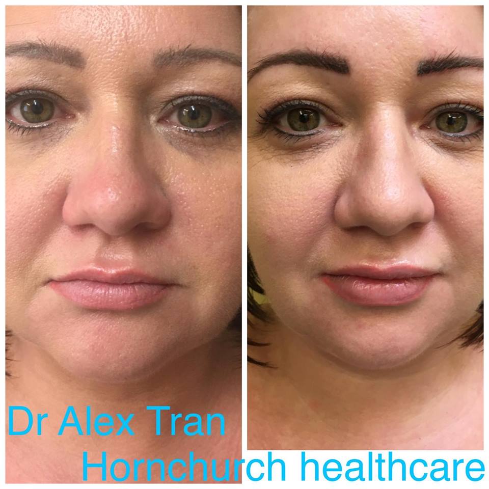 Lip Augmentation with Dr Tran at Hornchurch Healthcare
