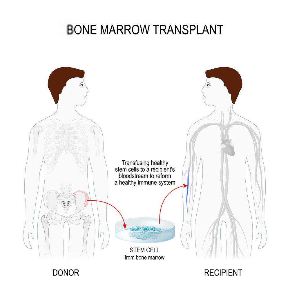 9 unknown facts to know about bone marrow transplantation