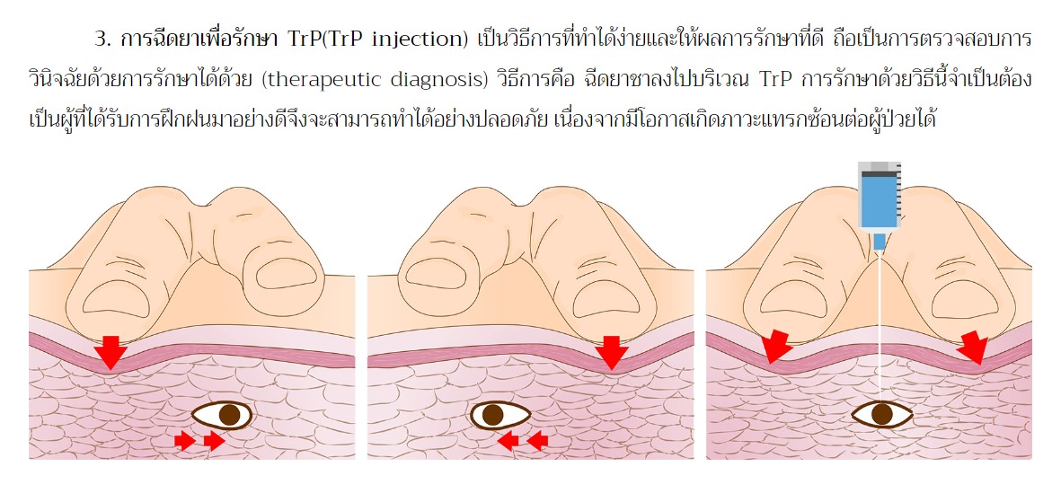 Drrattawach-teach: Trigger point injection