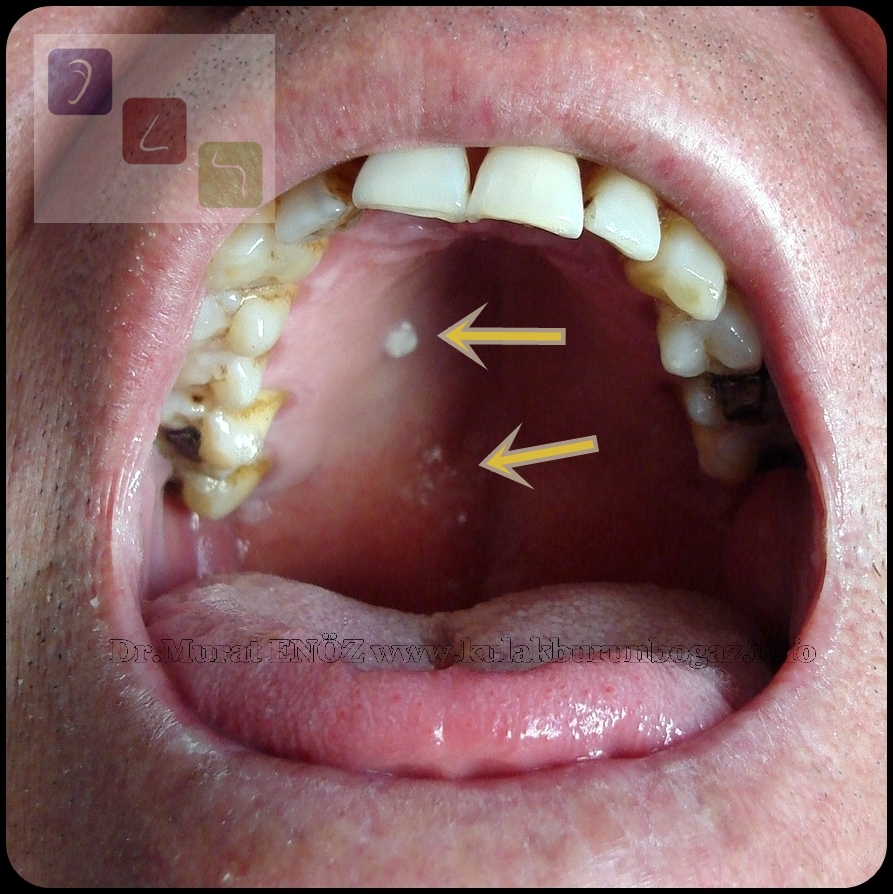 lichen-planus-mouth