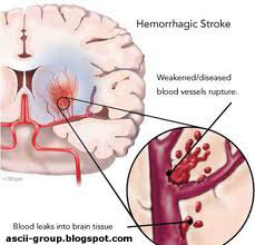 أربع مسببات للسكتة الدماغية عند الرجال Stroke in men أربع مسببات للسكتة الدماغية عند الرجال Stroke in men