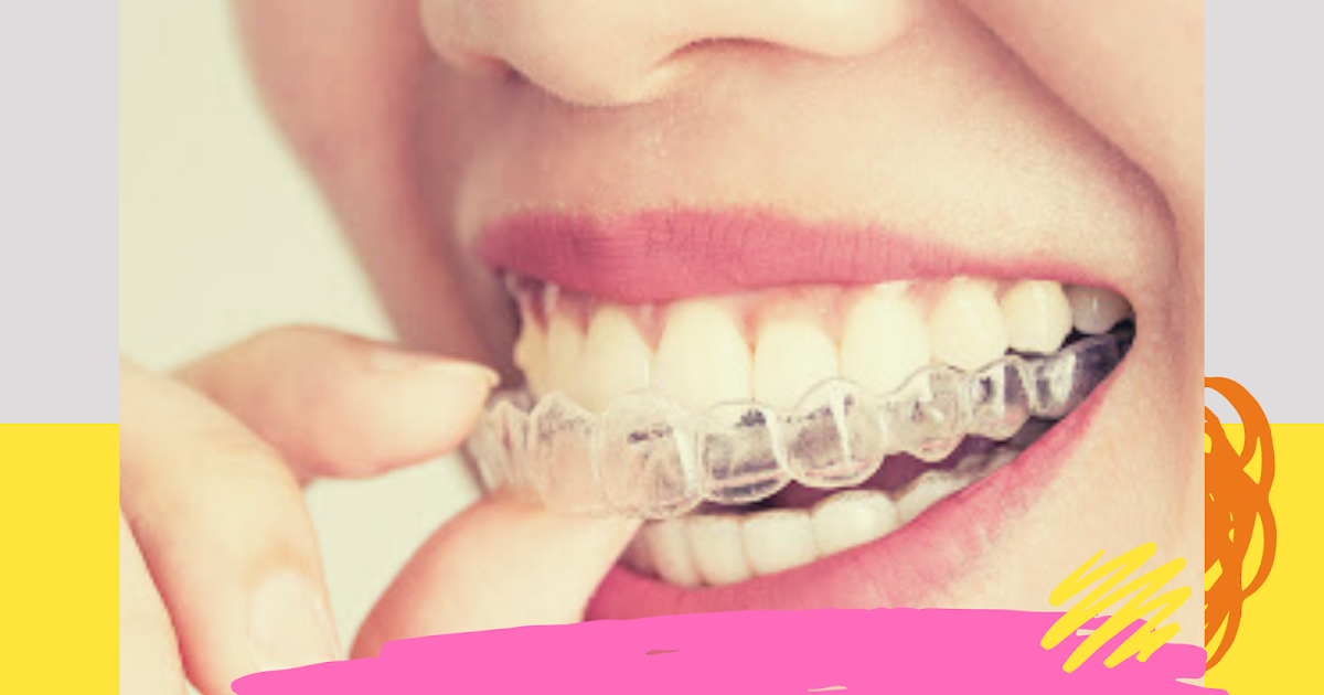 invisible braces company invisible braces company