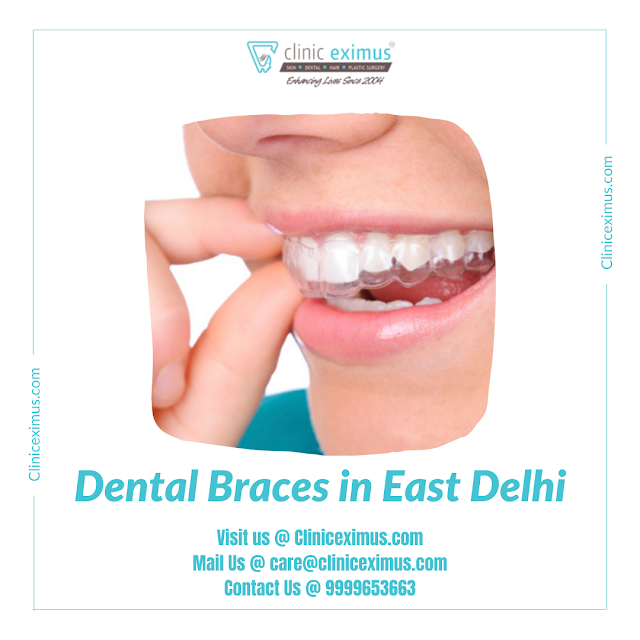 Dental Braces in East Delhi