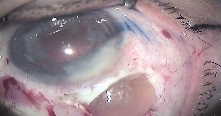 Cataract Surgery to See Clearly Eye Problems