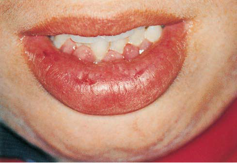 Lesions of Lip and Tongue - IOSR Journals