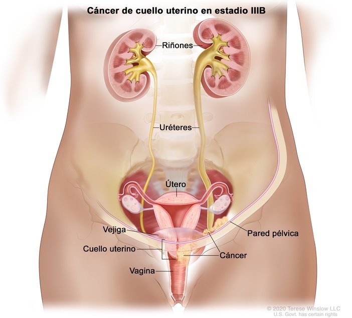 Cancer de Cuello Uterino