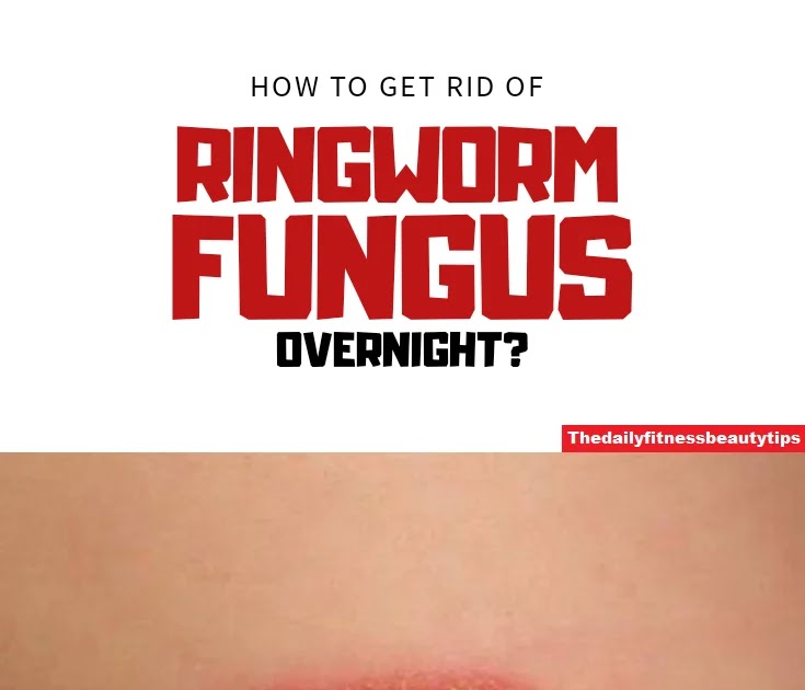How To Get Rid Of Ringworm Permanently?