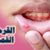 تقرحات الفم واهم البروتوكولات الدوائية لعلاجها تقرحات الفم واهم البروتوكولات الدوائية لعلاجها