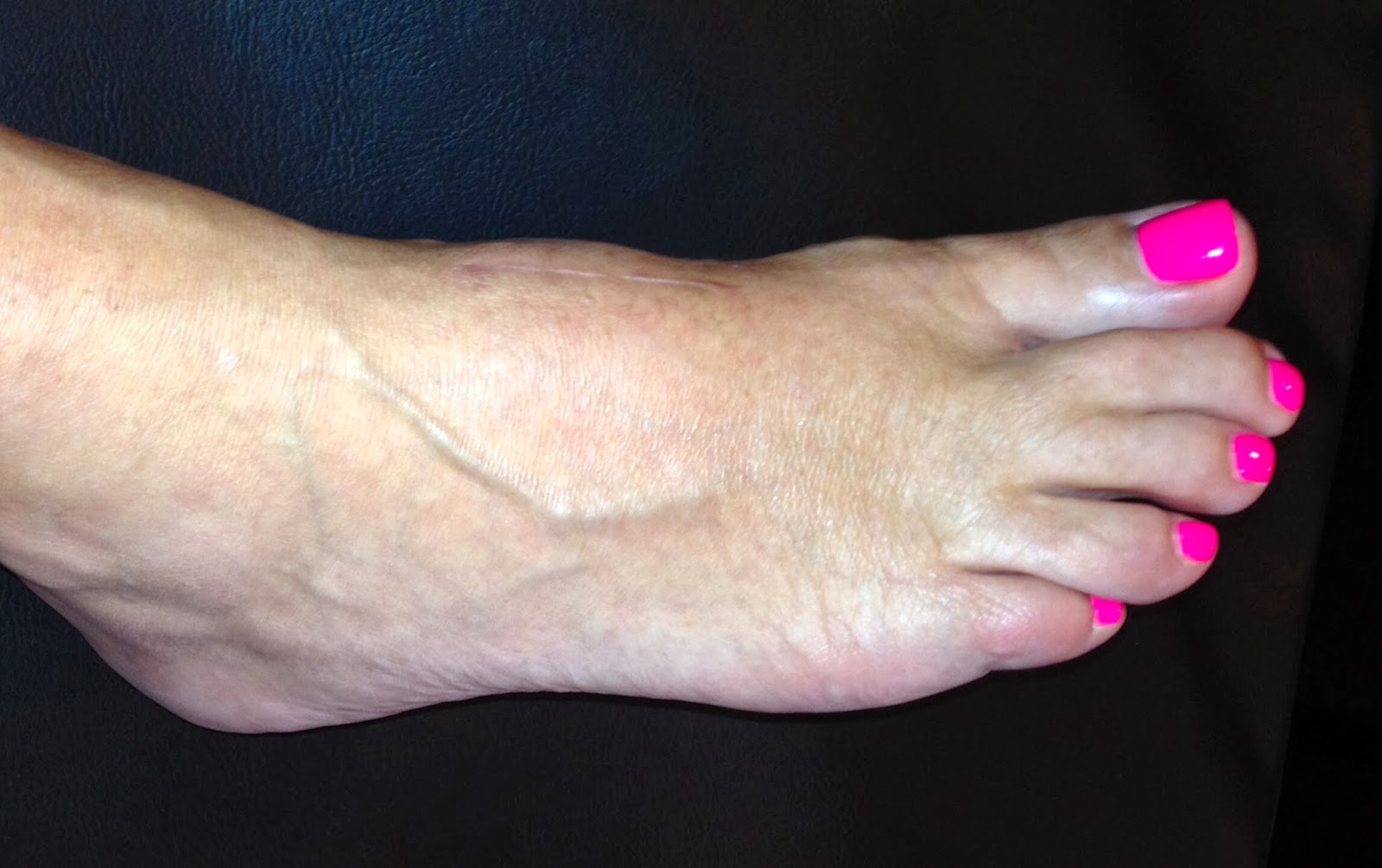 After LisFranc Surgery 23 weeks post lisfranc surgery