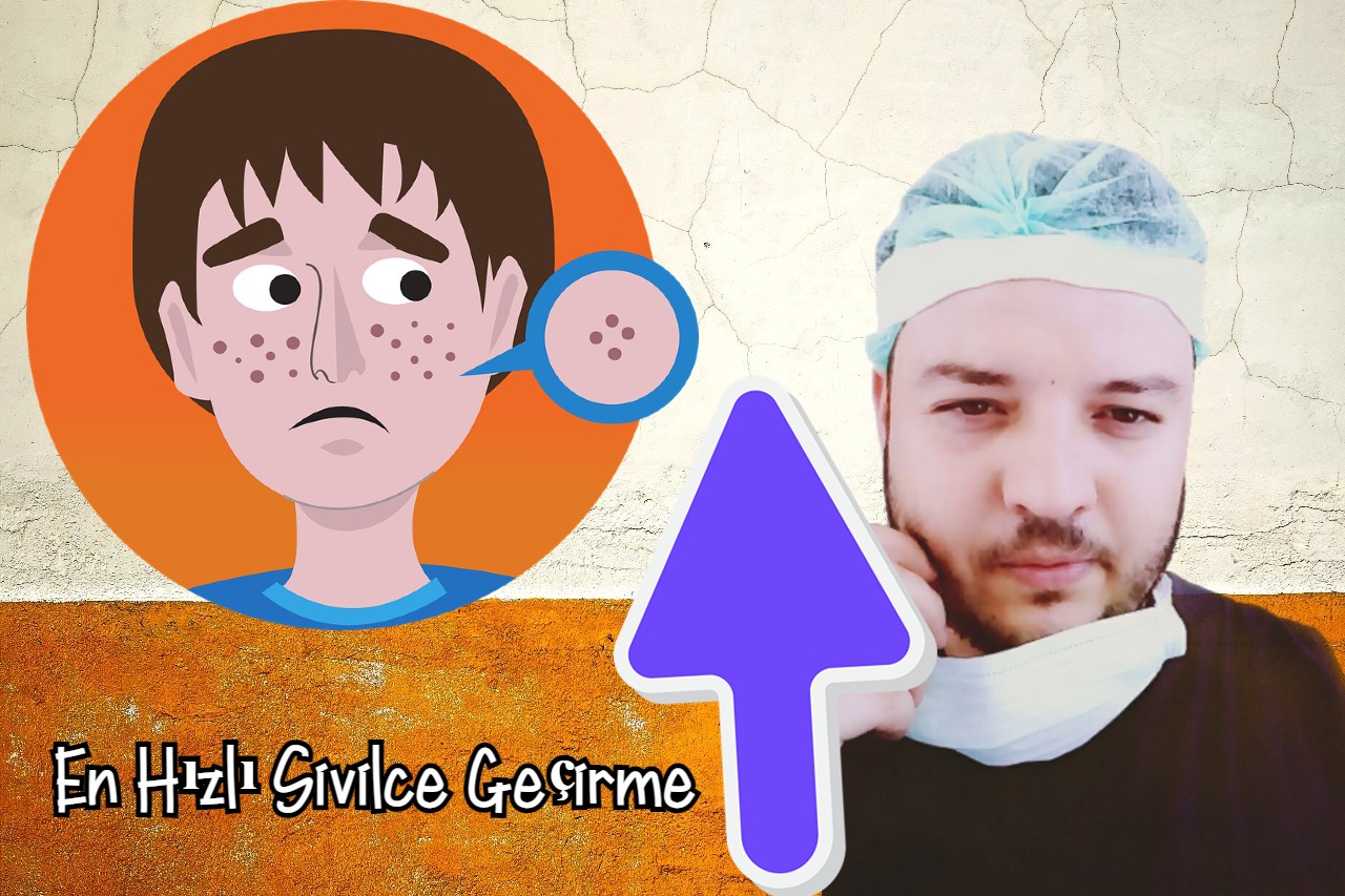 en hizli sivilce gecirme yontemi