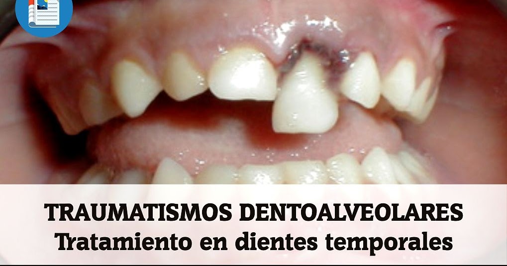 TRAUMATISMOS DENTOALVEOLARES Tratamiento en dientes TRAUMATISMOS DENTOALVEOLARES Tratamiento en dientes