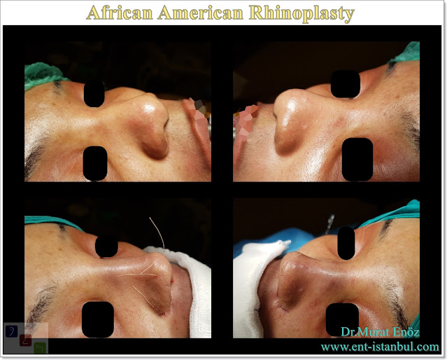 African American rhinoplasty,Thick skin nose job,Ethnic expert rhinoplasty surgeon,Black nose job,Ethnic Rhinoplasty Istanbul,