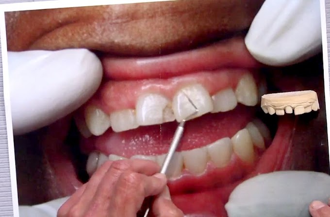 PROSTHODONTICS: Why a Shade Tab is Necessary for a Clinical Photograph