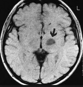 Kanker Otak Stadium 2 : Gejala, Gambar, Diagnosis, dan Pengobatannya
