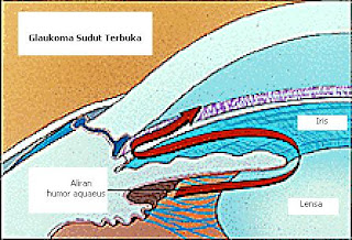 SEHAT ITU PENTING: GLAUKOMA AKUT