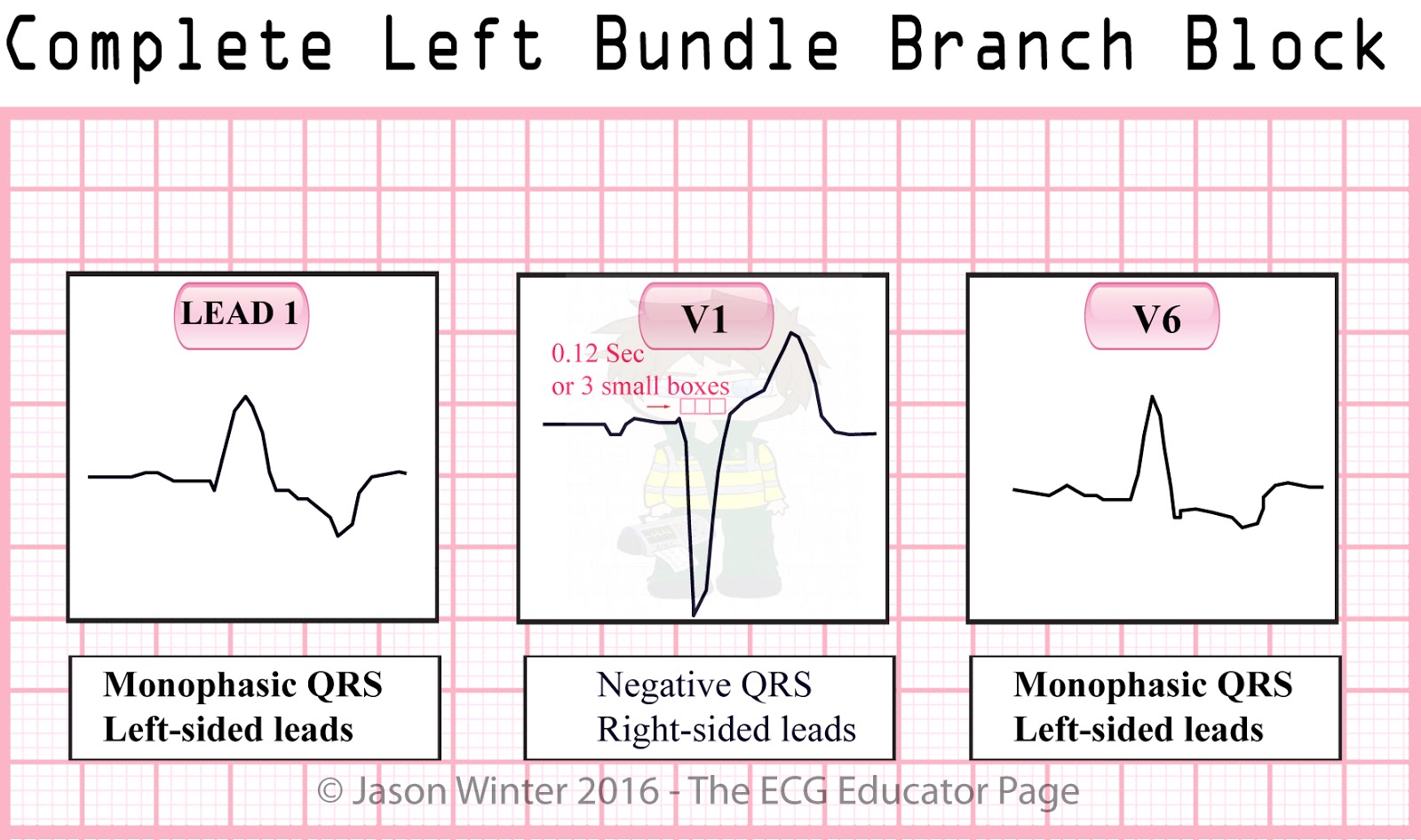 Right And Left Bundle Branch Block