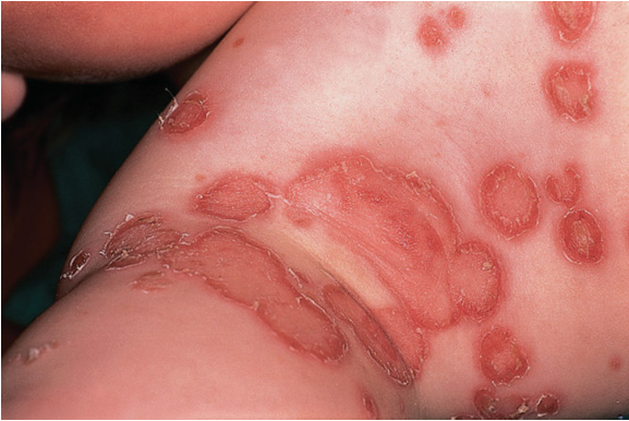 IMPETIGO infection - Healthline