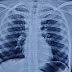 A Metallic Pin Successfully Removed from A Child’s lung After 2 Years at Zen Multispecialty Hospital, Chembur