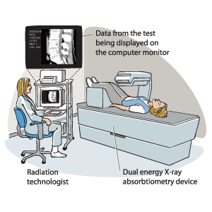 Osteoporosis Weak Bones need Bone Health Vitamins BMD test