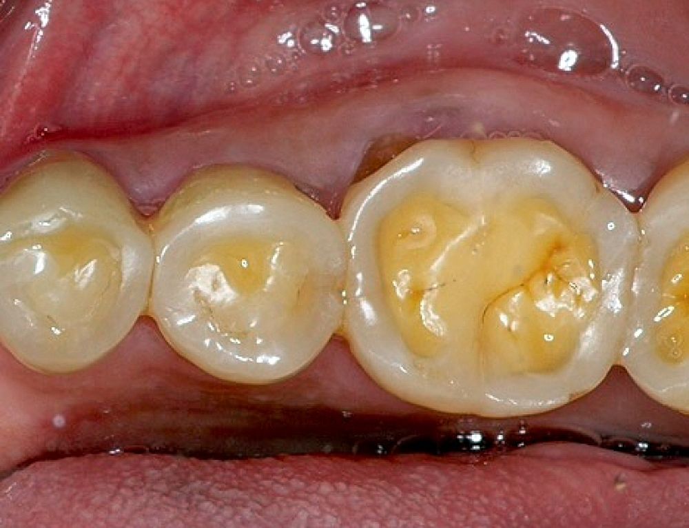 Protect your teeth from the effects of Acid Wear with these top tips