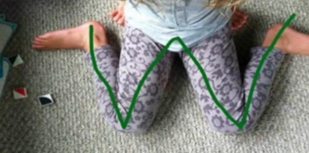 Jika Anak Sering Duduk Membentuk Huruf W Seperti ini Jangan Dibiarkan