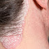EKSIM ATOPIK thumbnail