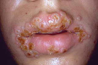 Herpes-738480.jpg