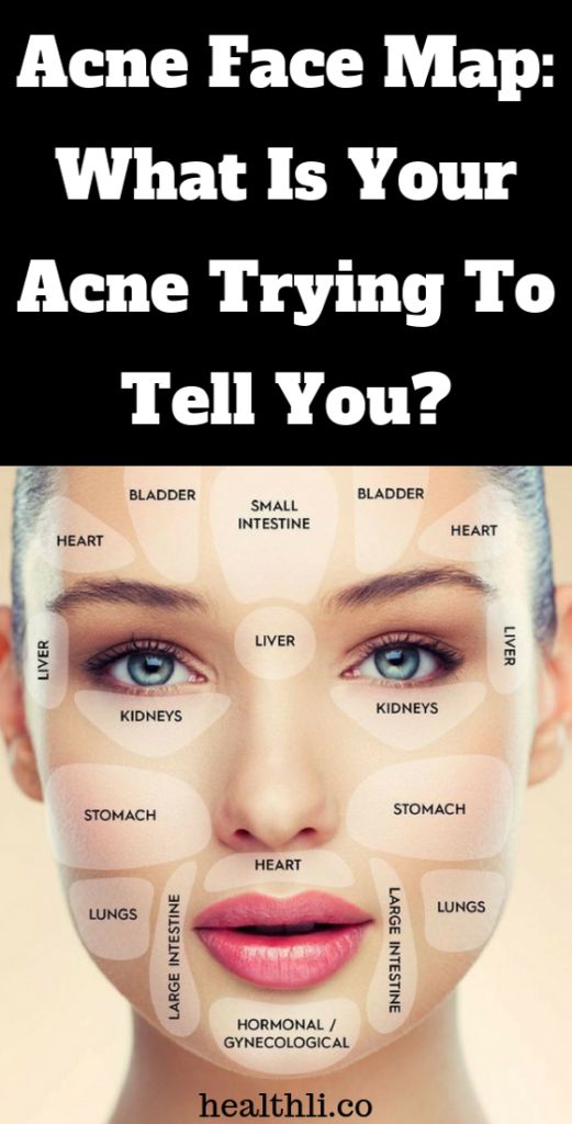 Acne Face Map What Is Your Acne Trying To Tell You Health0medical