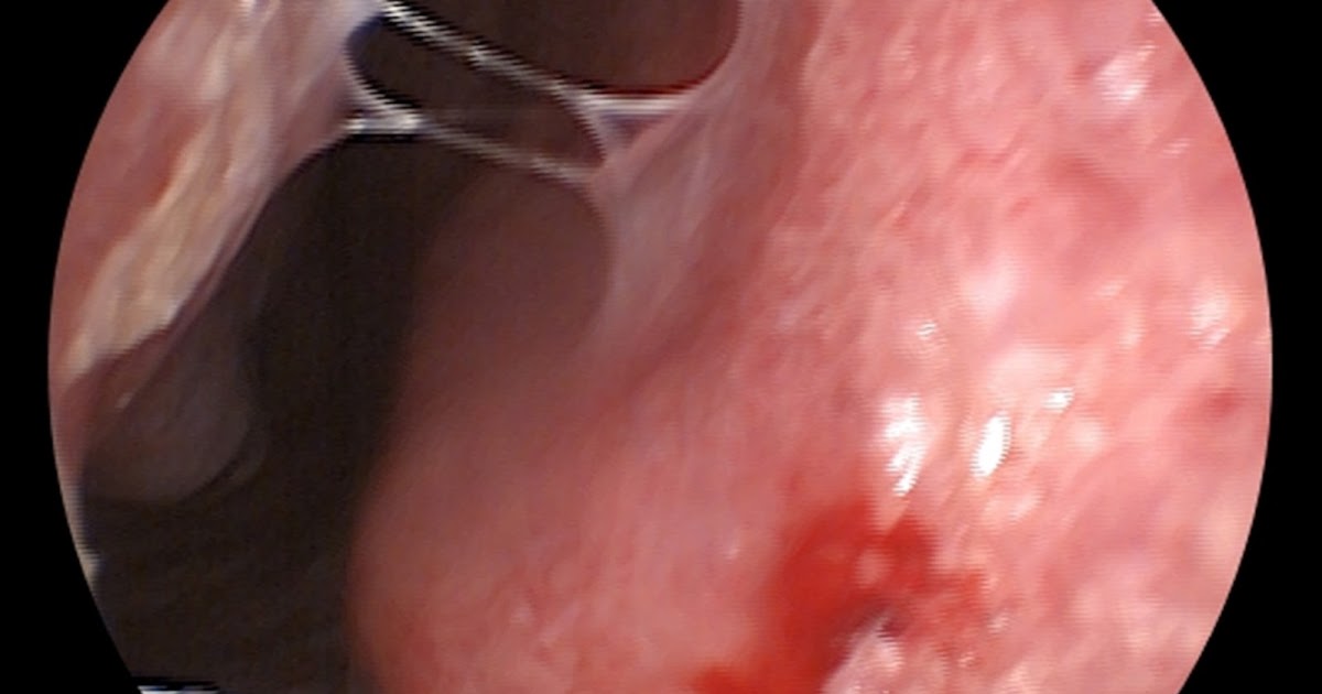 Soğuk Havalarda Burun Ameliyatları Sonrasında Burun Kuruluğu Fazla