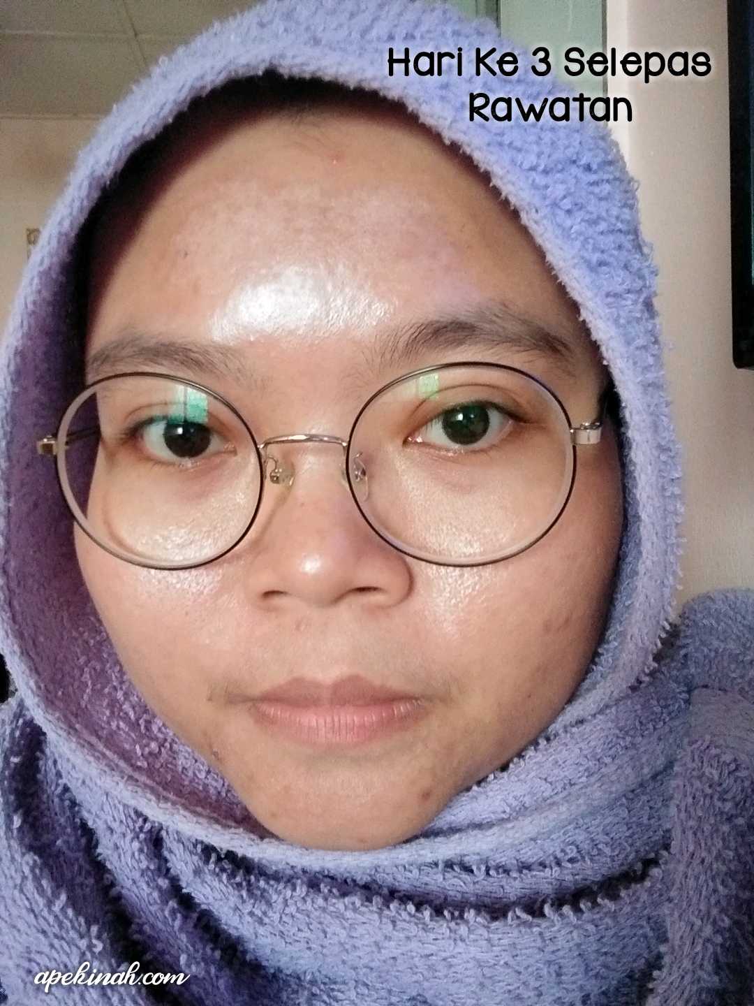 Buat Rawatan OxyPeel C Untuk Merawat Parut Di Dr Medispa & Wellness Buat Rawatan OxyPeel C Untuk Merawat Parut Di Dr Medispa & Wellness