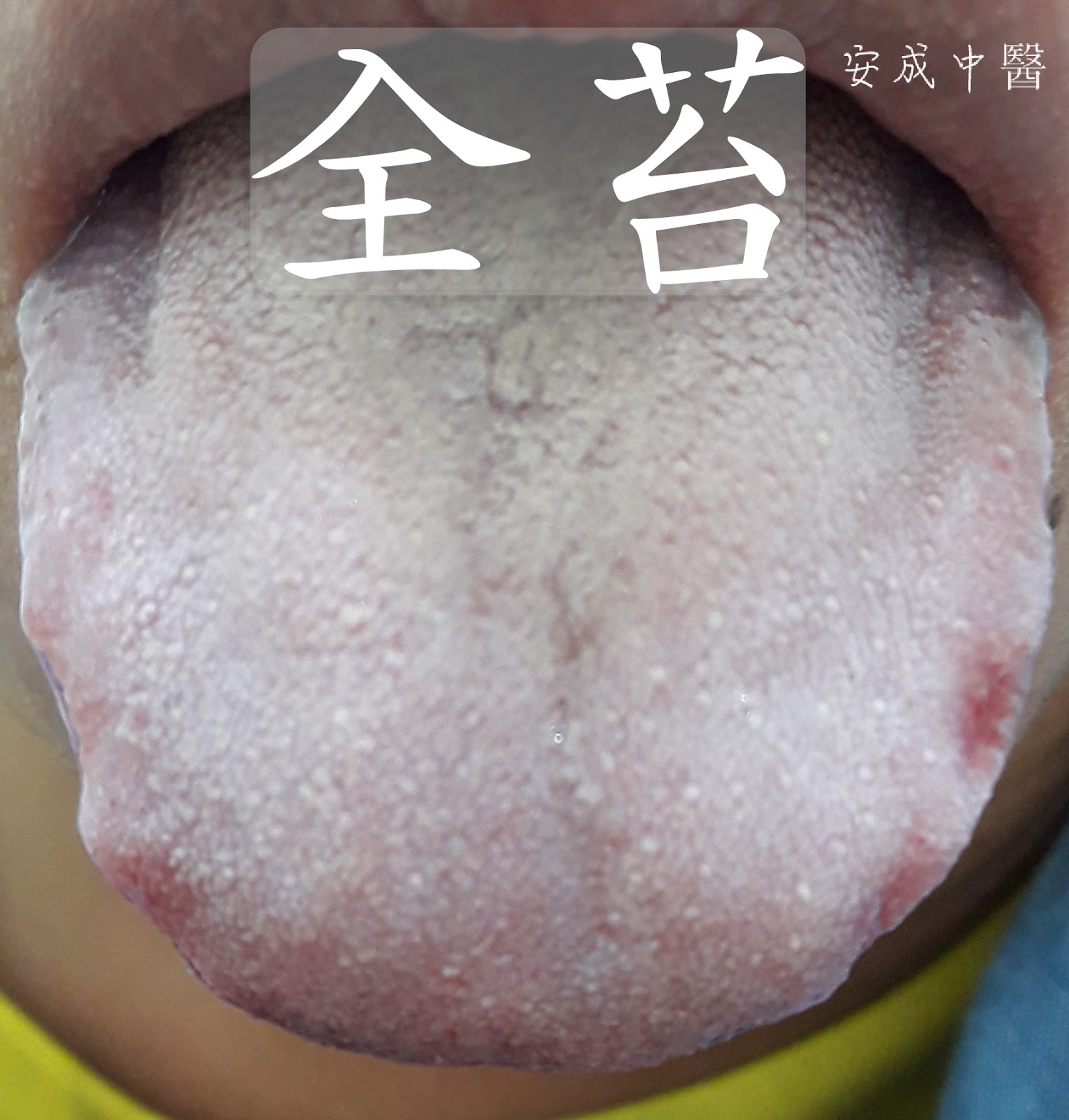 舌头有裂纹图 (8)_有来医生