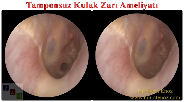 Tamponsuz kulak zarı ameliyatı - Tamponsuz kulak zarı ameliyatı nasıl yapılır? - Tamponsuz kulak zarı ameliyatı fiyatı - Tamponsuz kulak zarı operasyonu - Tamponsuz kulak zarı tamiri - Kulak tamponu kullanılmadan kulak zarı ameliyatı - Kulak tamponu kullanılmadan kulak zarı deliği tamiri - PureRegen Gel Otol - Eardrum repair in İstanbul - PureRegen® Gel OTOL