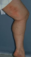 leg with superficial phlebitis