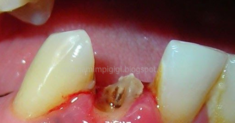 99 Arti Mimpi Gigi Bawah Depan Copot 1, 2, 3, Atau 4 Menurut Primbon Jawa  Dan Tafrsir Islam Lengkap - Mimpi Gigi