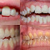 Nên bọc răng hàm dưới trong trường hợp nào? 