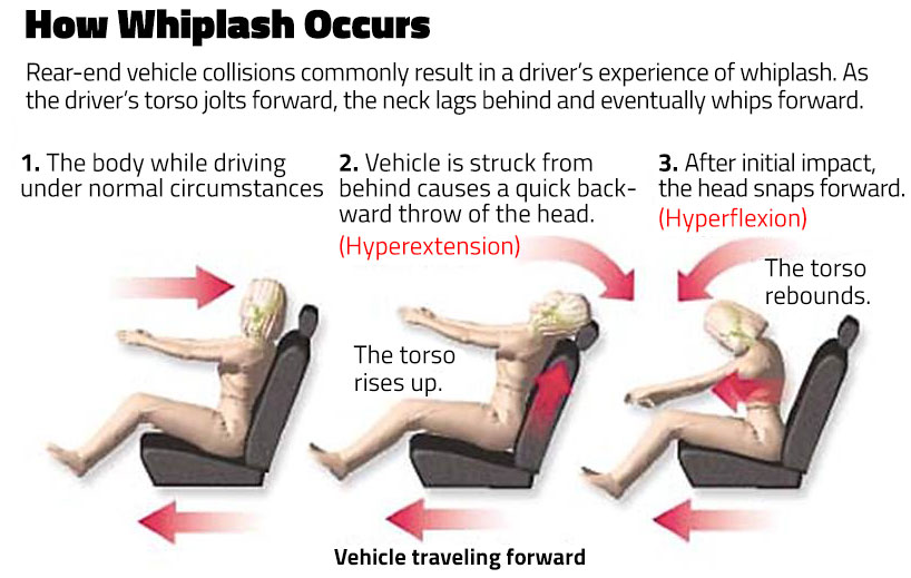 The Health Hub Whiplash Treatment