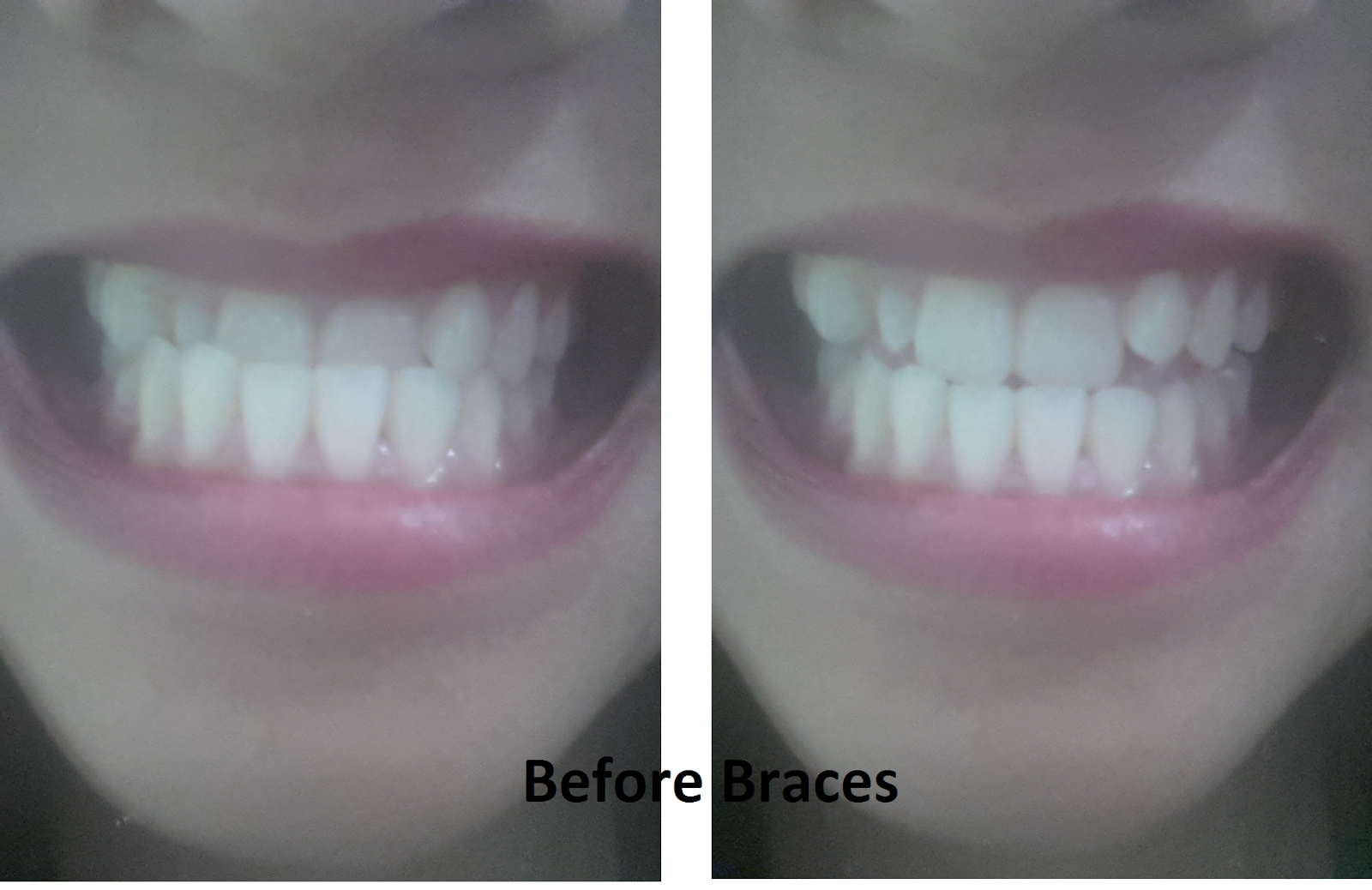 My Braces Journey 1 month after braces