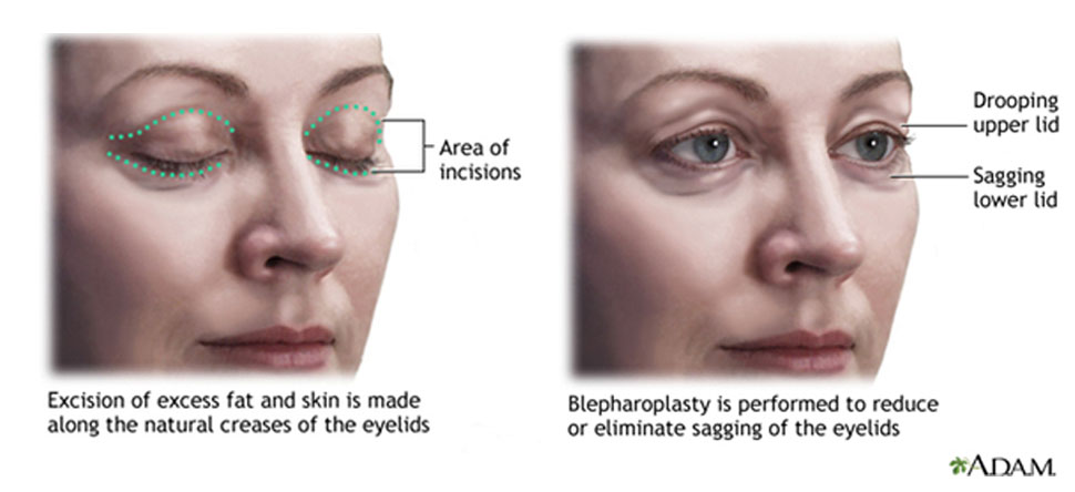 WHAT ARE THE STEPS OF AN EYELID SURGERY PROCEDURE?