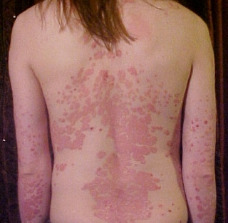 Psoriasis Psoriasis typically waxes and wanes with periods of relapse and remission.
