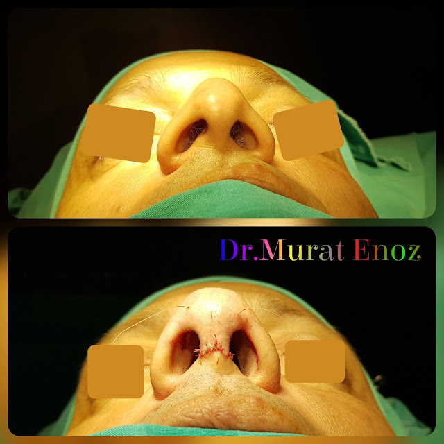 Droopy Nose Tip Aesthetic in Istanbul,Nose Tip Plasty in Istanbul, Ptotic Nasal Tip, Nose Tip Lifting,