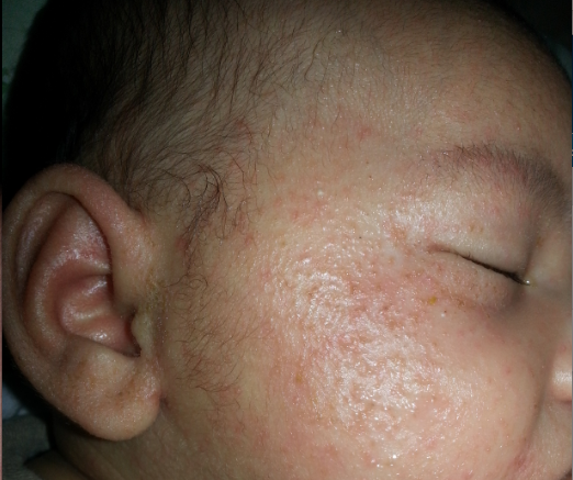 Facial Skin Bumps 65