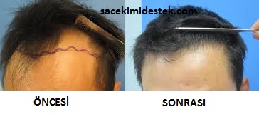 sakaklara yanlara sac ekimi sac