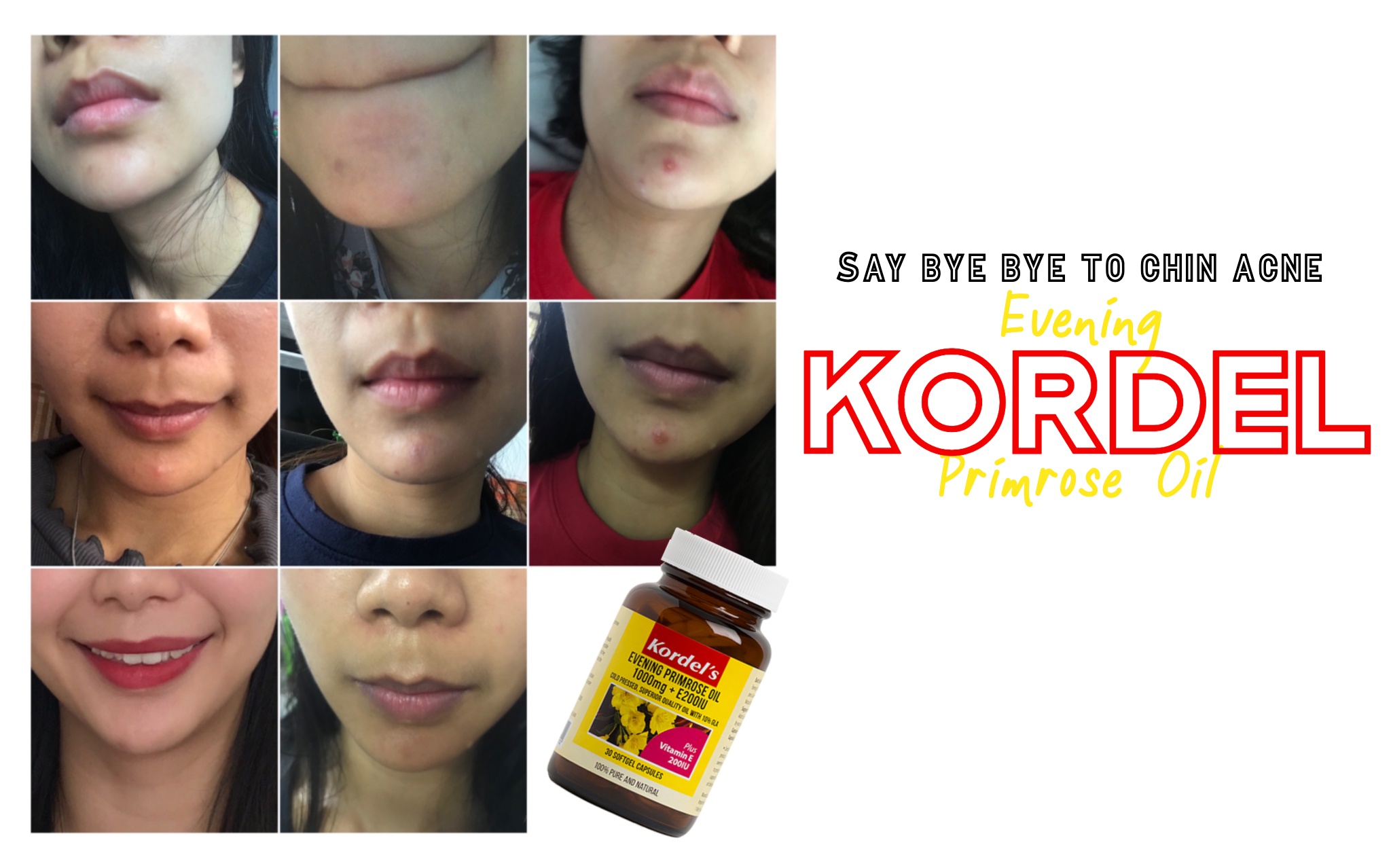 get rid of hormonal chin acne