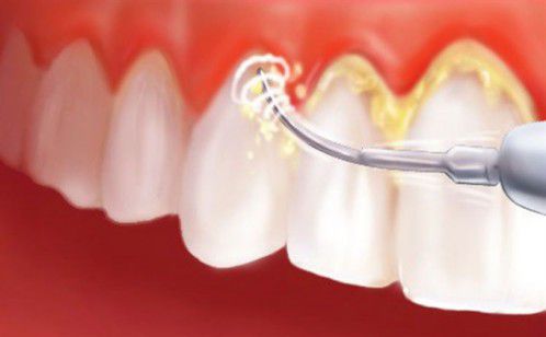 Lấy cao răng bằng máy siêu âm giá bao nhiêu 1 lần lấy? Lấy cao răng bằng máy siêu âm giá bao nhiêu 1 lần lấy?
