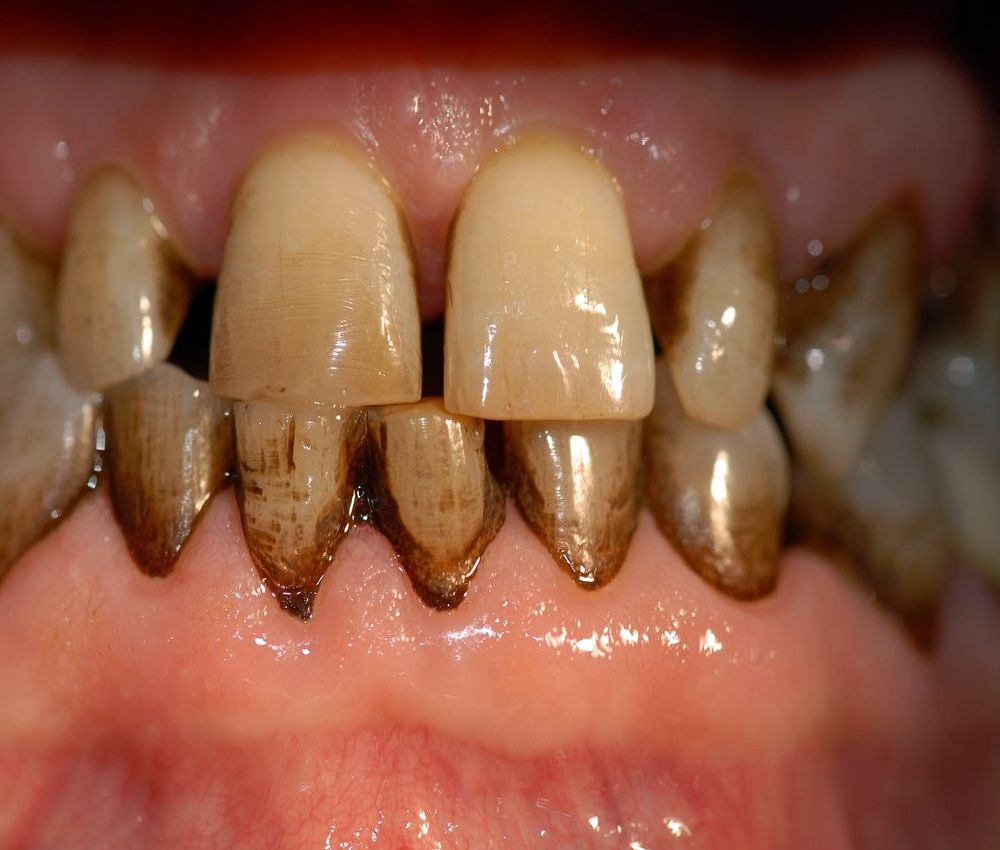 manchas-dentales