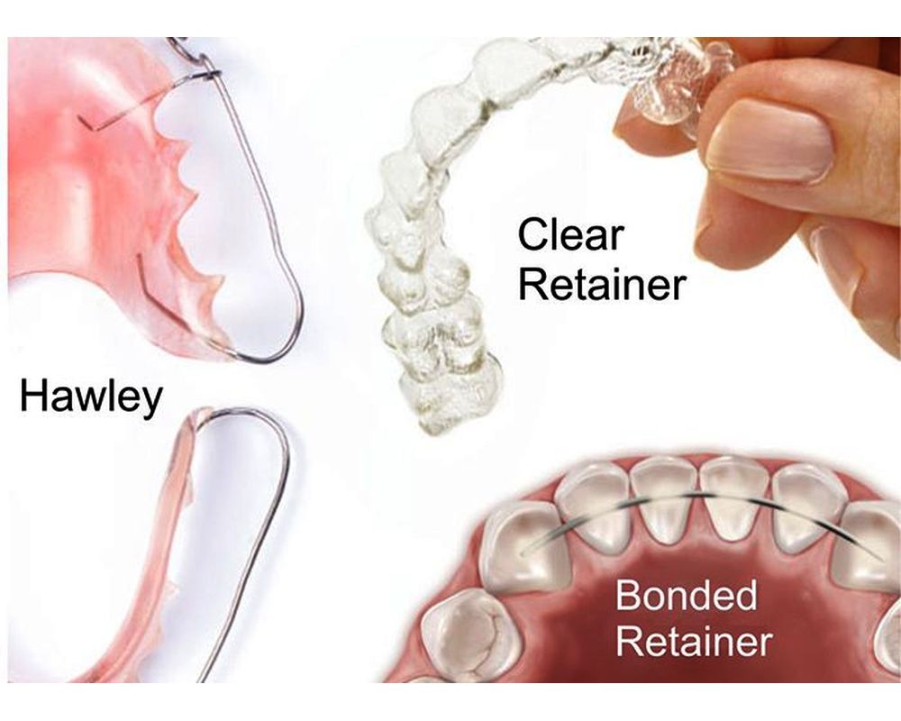 Cuanto tiempo se usan los retenedores dentales